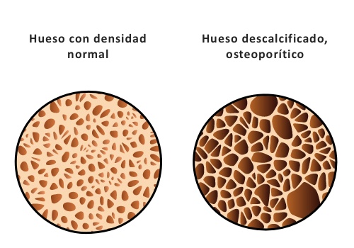 osteoporosis-in-mubu